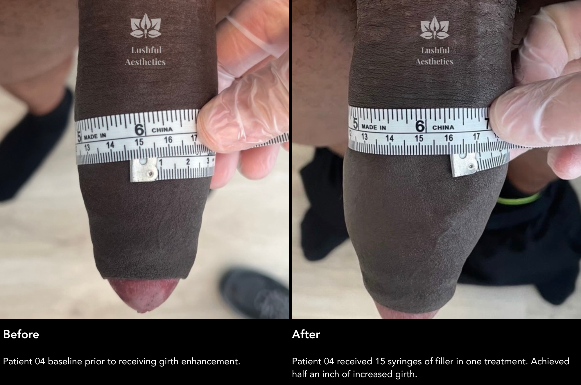 Girth enhancement (penis filler) before and after treatment photos growing your penis's girth by half an inch.