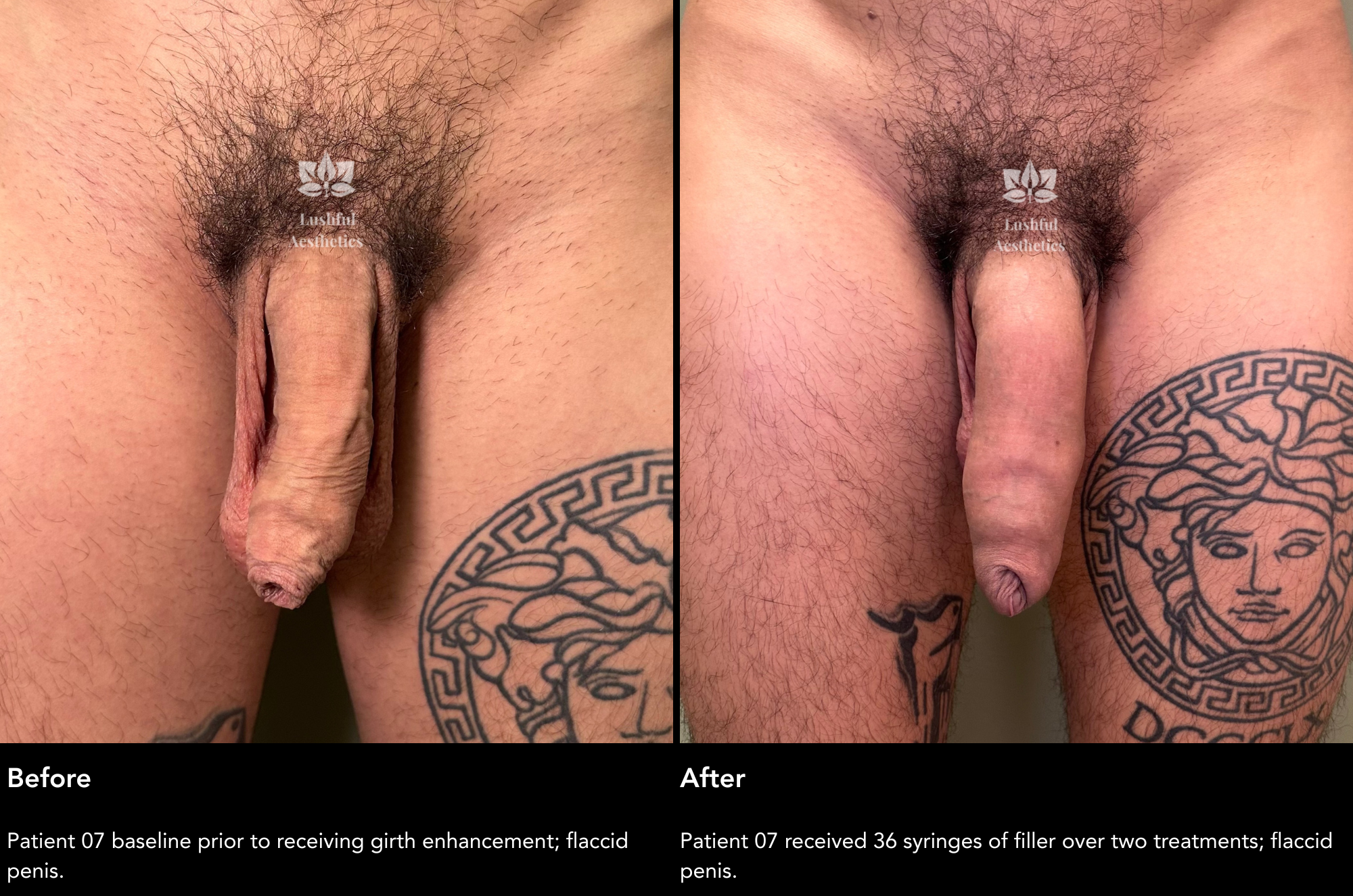 Girth enhancement (penis filler) before and after treatment photos to get a thicker dick.