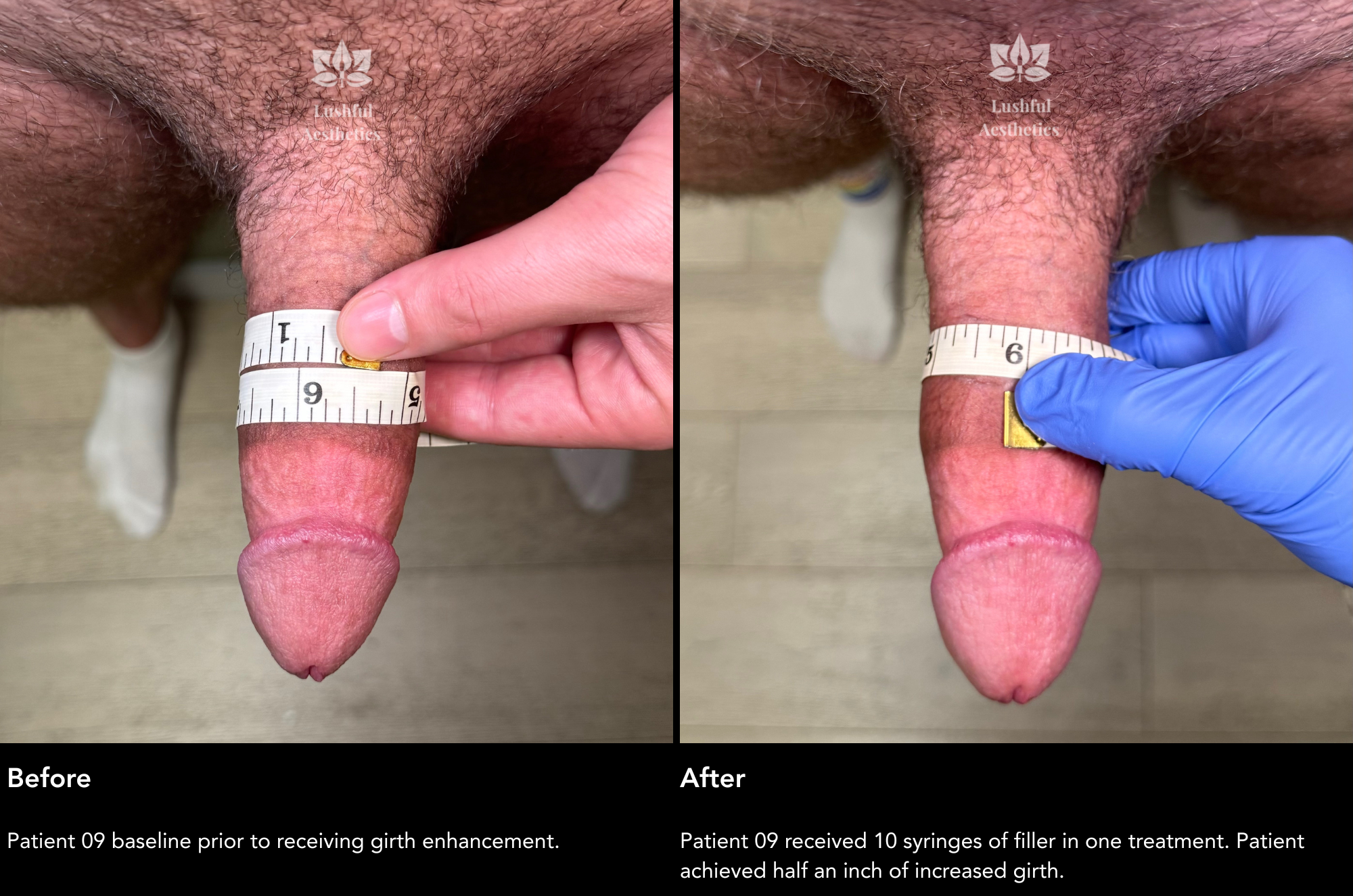 Girth enhancement before and after photos.