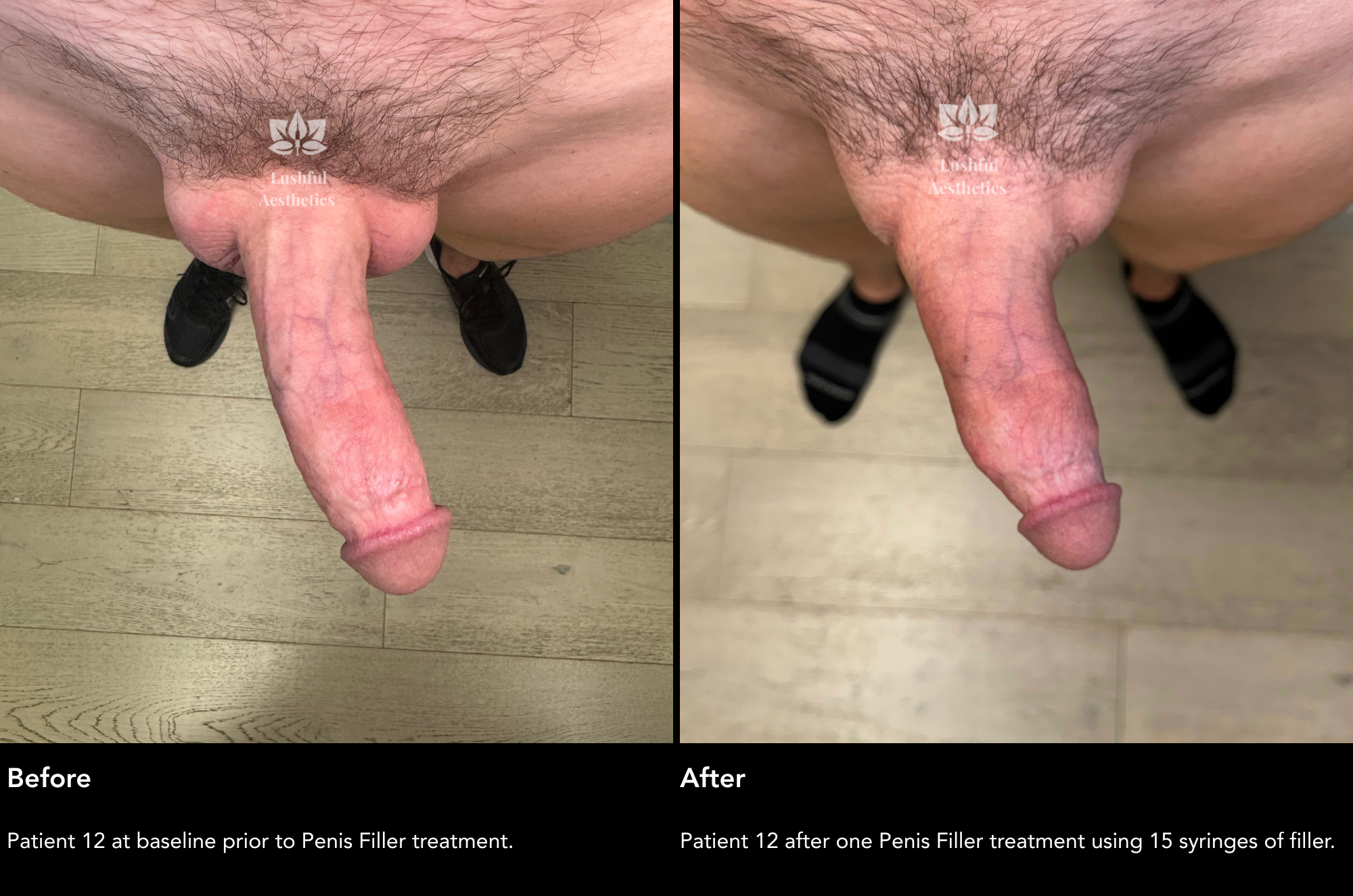 Girth enhancement (penis filler) before and after treatment photos to grow a thicker dick.