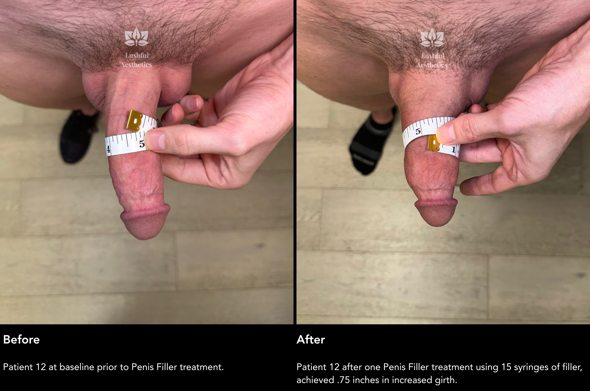 Penis filler before and after treatment photos to grow girth by .75 inches.