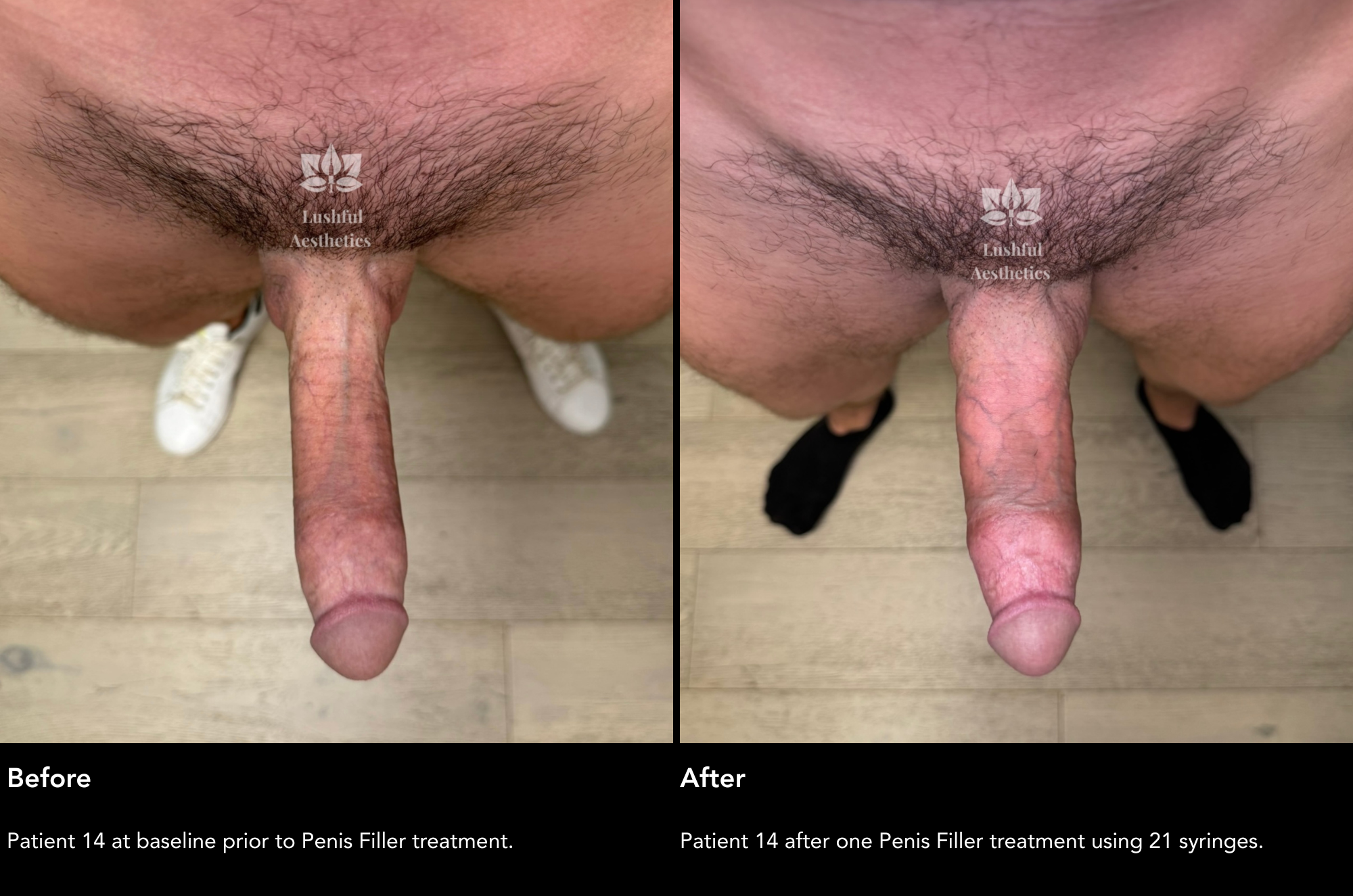 Penis filler before and after erect photos.