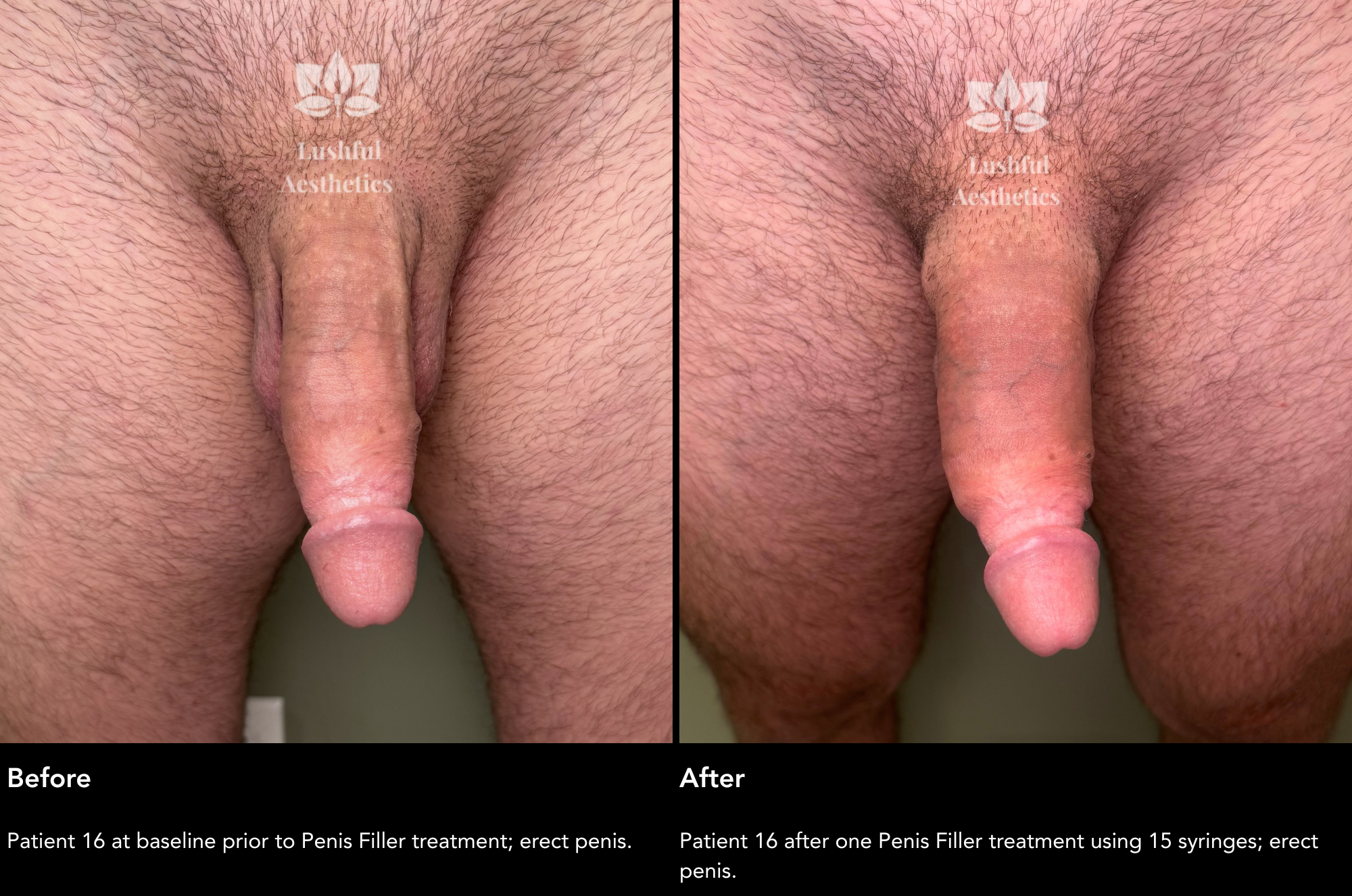 Girth enhancement before and after photos showing an increase of flaccid penis girth even when erect.