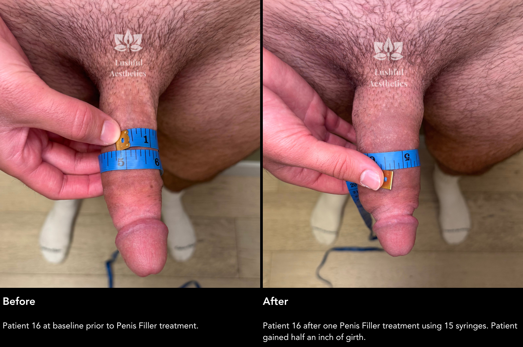 Girth enhancement (penis filler) before and after treatment photos to increase penis thickness.