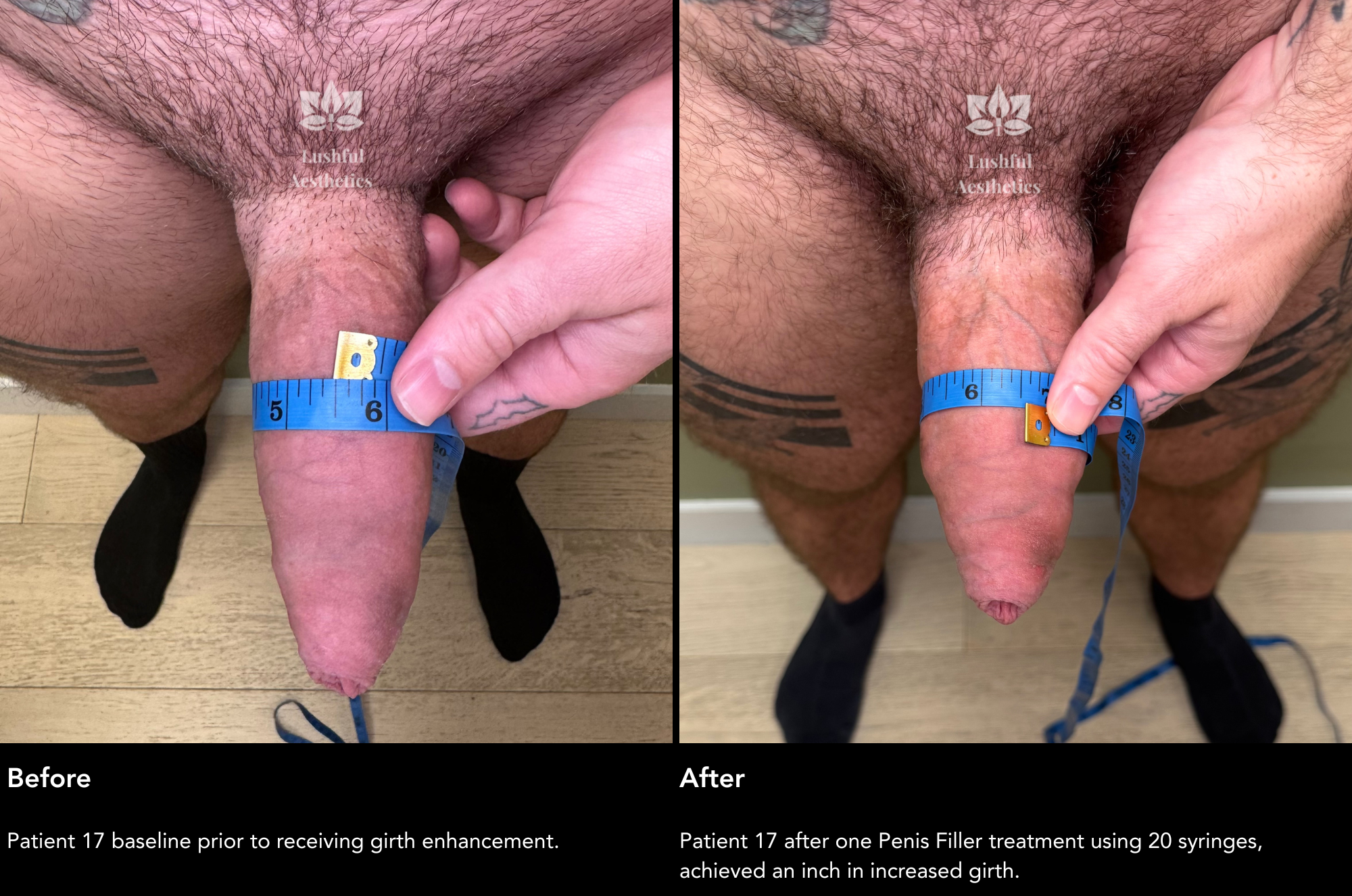 Girth enhancement before and after photos showing an inch increase in girth.
