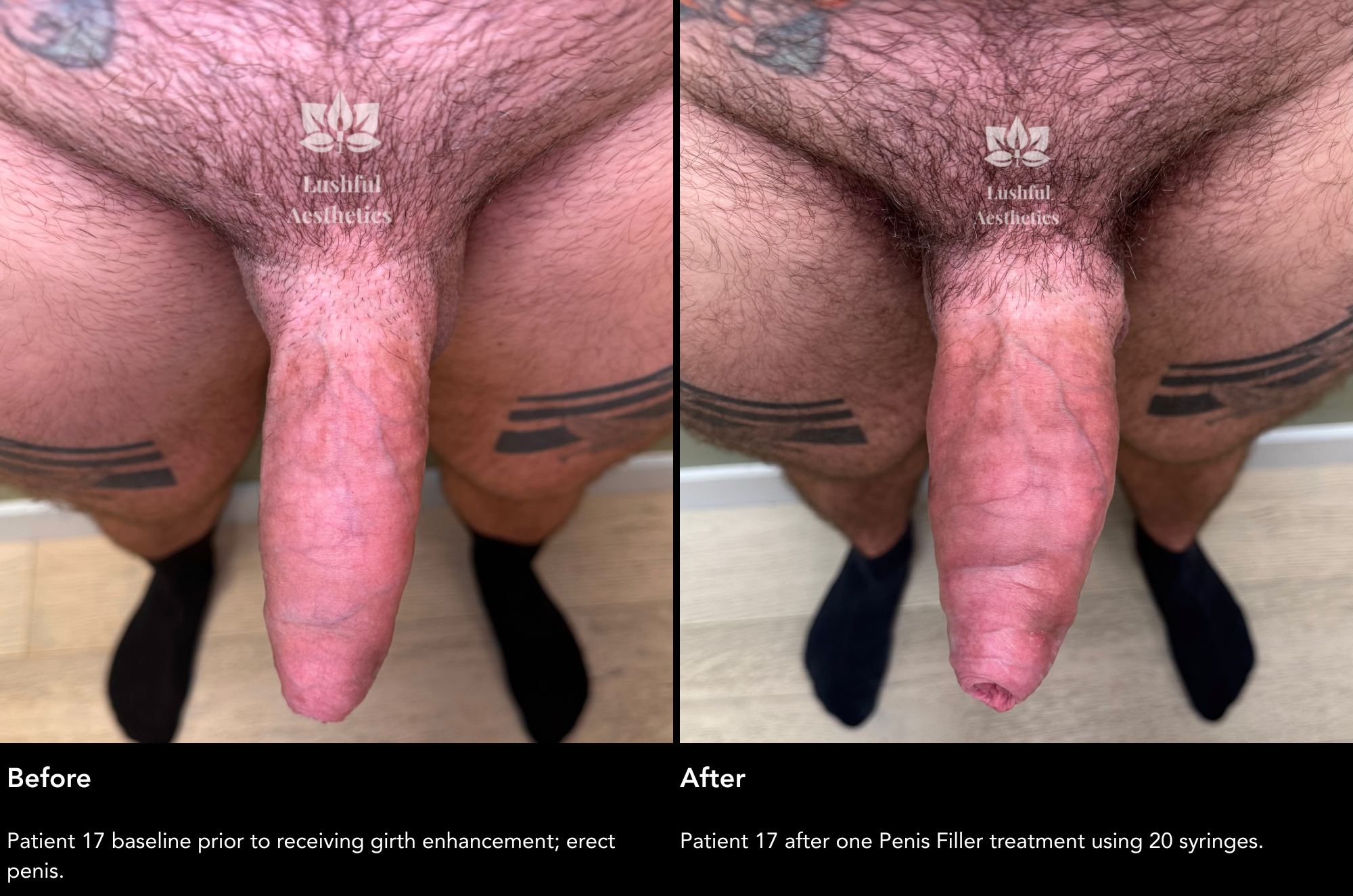 Girth enhancement (penis filler) before and after treatment photos to get a thicker penis.