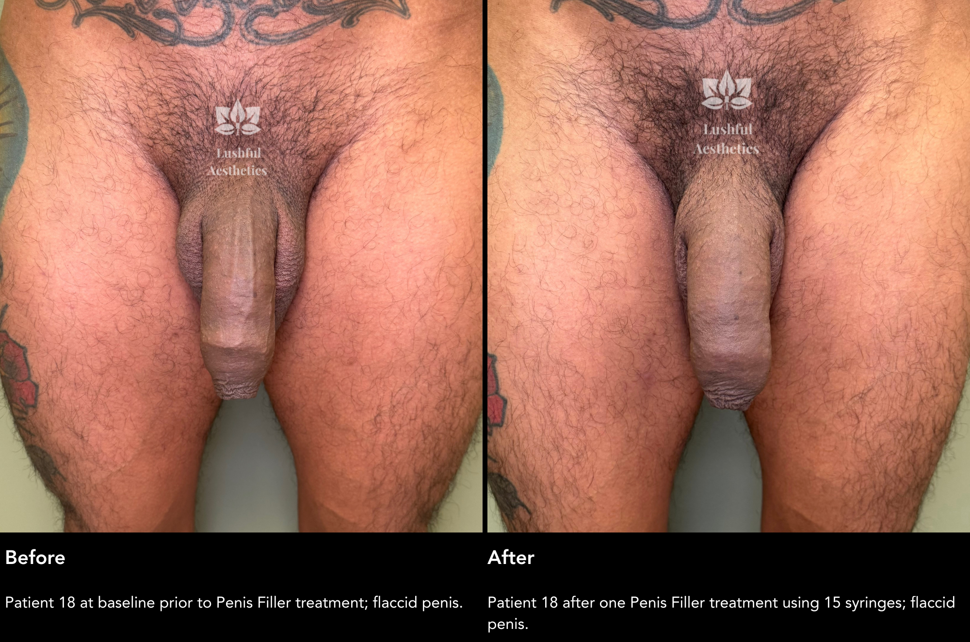 Girth enhancement (penis filler) before and after treatment photos to grow a thicker cock.