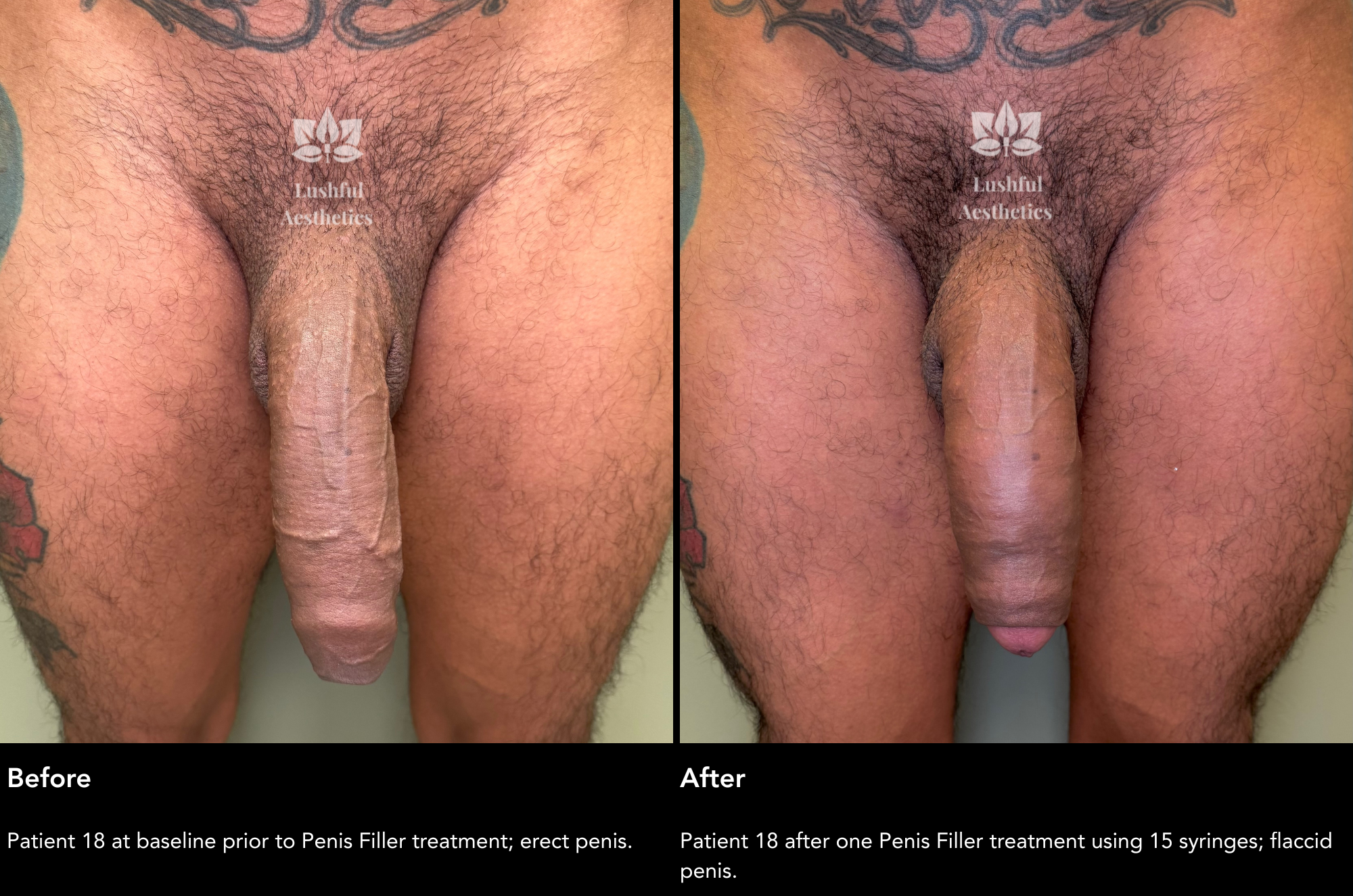 Penis filler treatment photos.